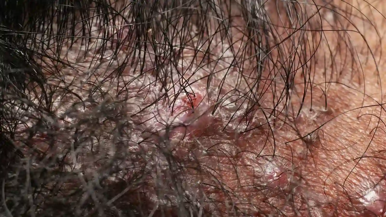 Burning Scalp, GlamorChiQ Memphis TN