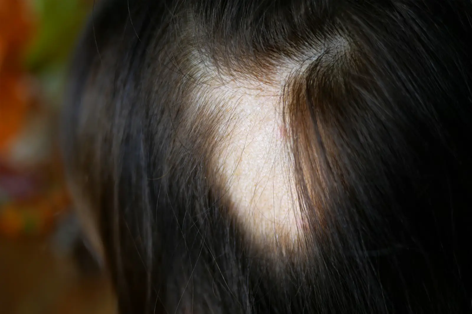 Traction Alopecia Treatment Memphis — GlamorChiQ Memphis TN