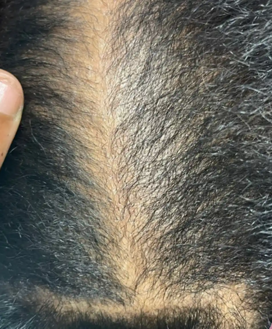 After — denser part line following scalp restoration treatment, GlamorChiQ Memphis