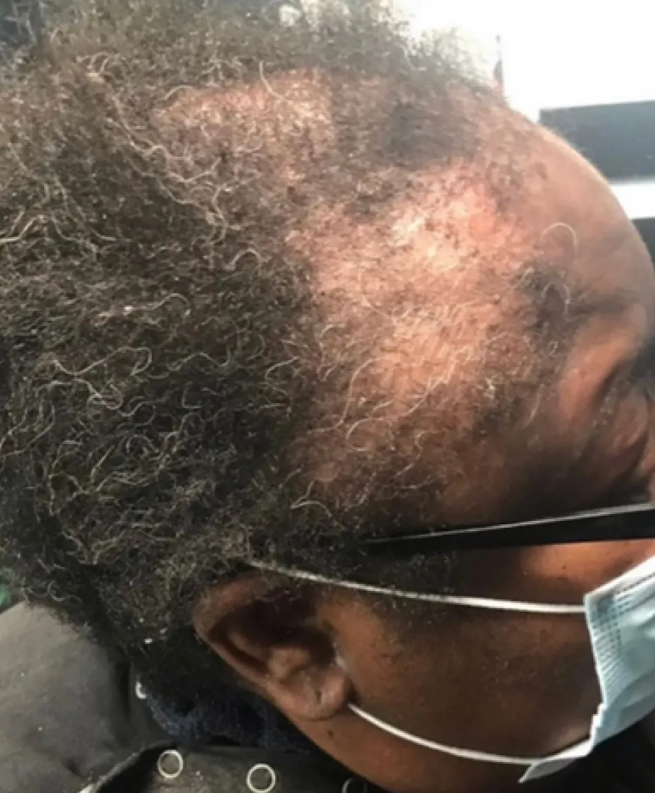 Before — thinning hair and visible scalp at the crown, Memphis client