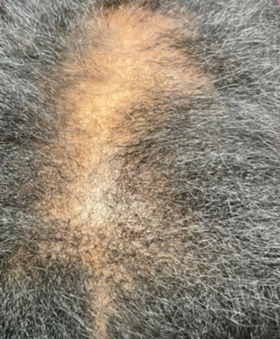 Before — widened part line and visible scalp thinning, Memphis client