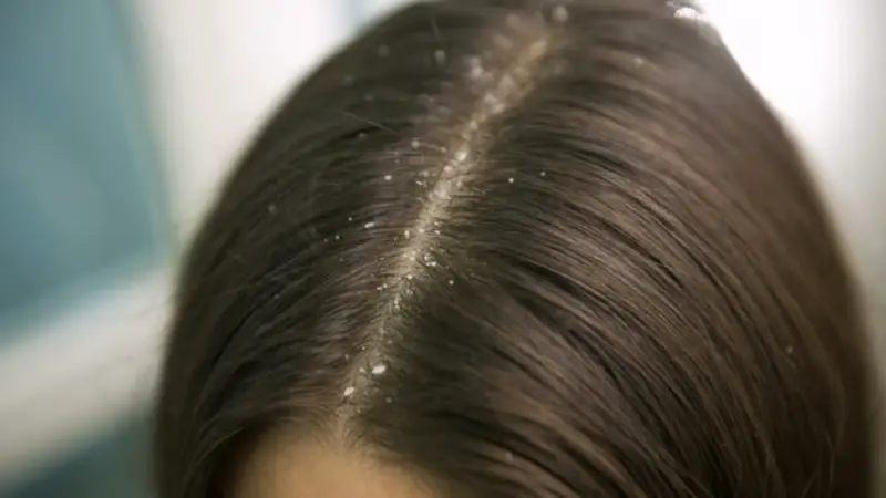 Oily Scalp and Dandruff — GlamorChiQ Memphis TN