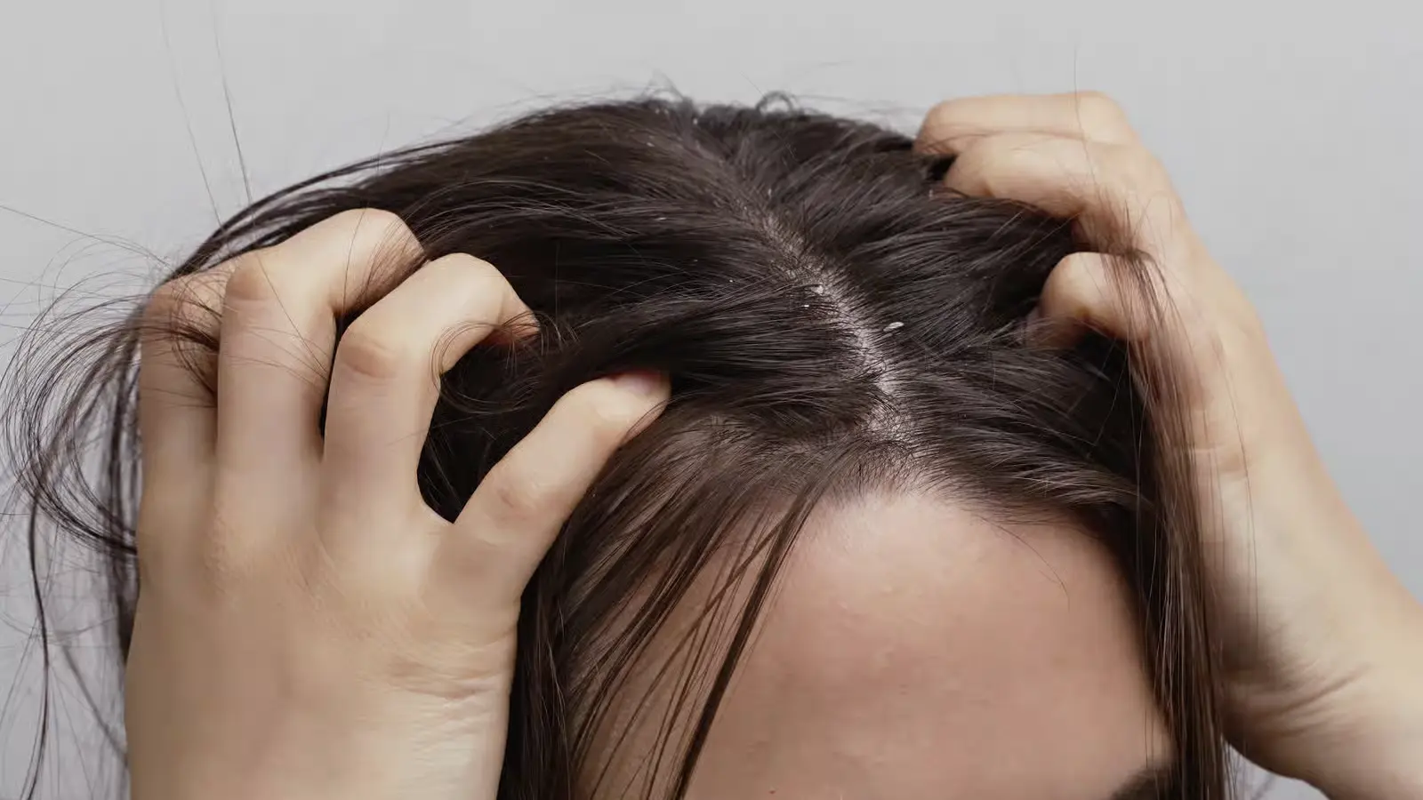 Scalp Eczema — GlamorChiQ Memphis TN